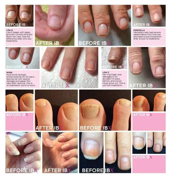 Damaged Nail Treatments in Southampton