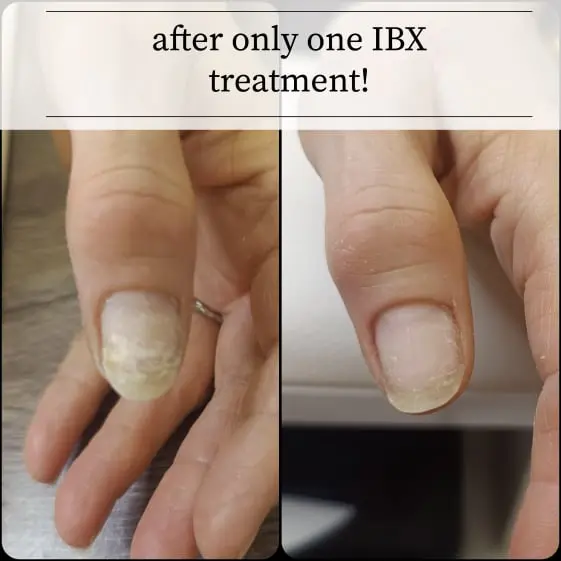 Damaged nail treatments Southampton