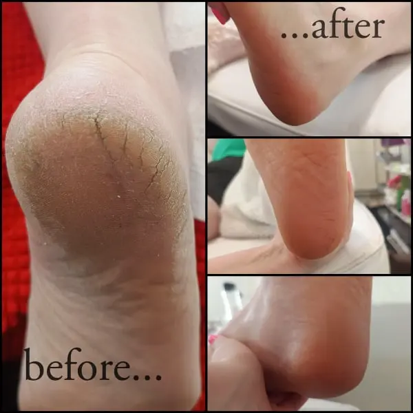 Pedicures & Callus removal in Southampton